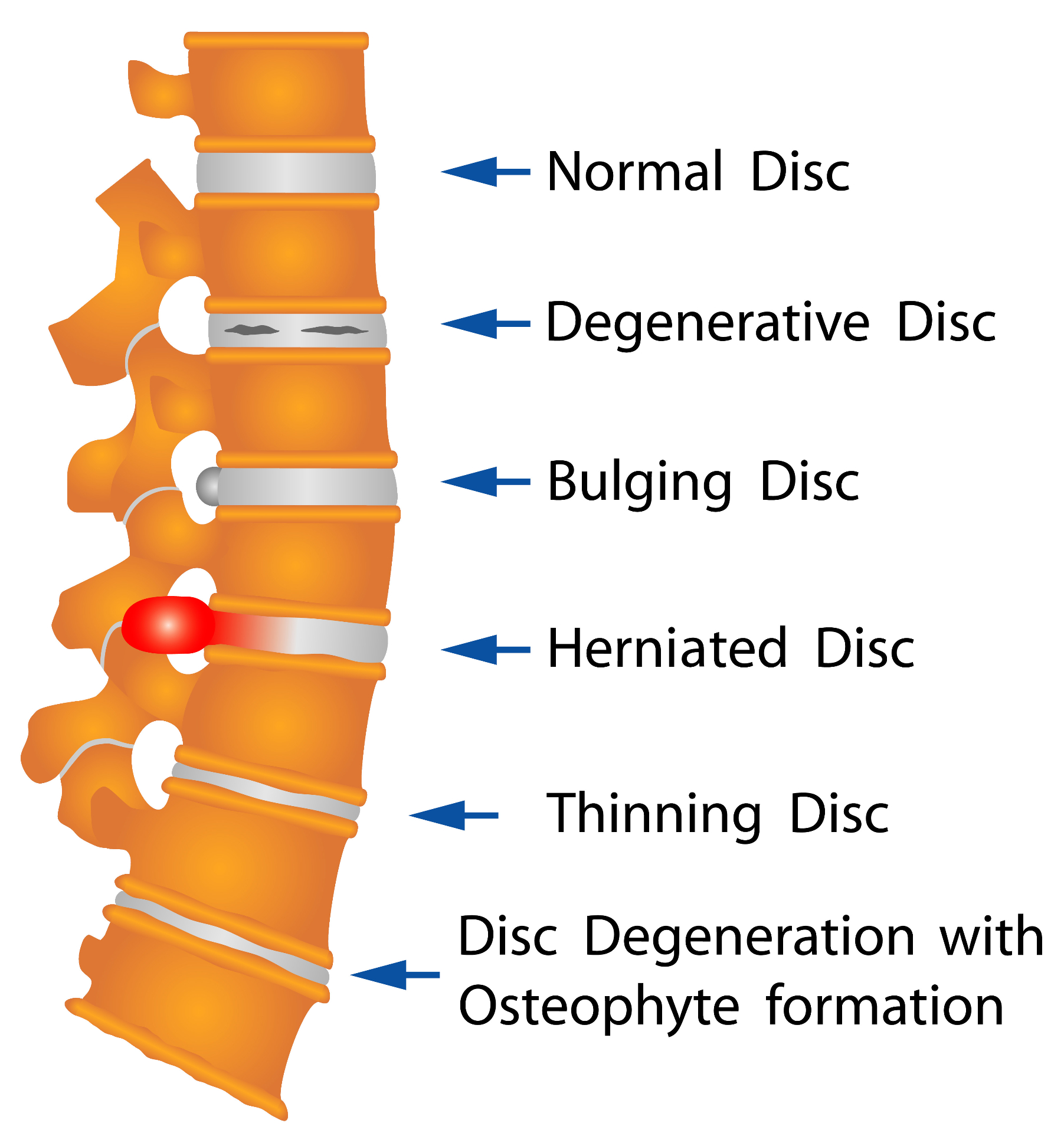 Disc conditions — normal, bulging, herniated discs
